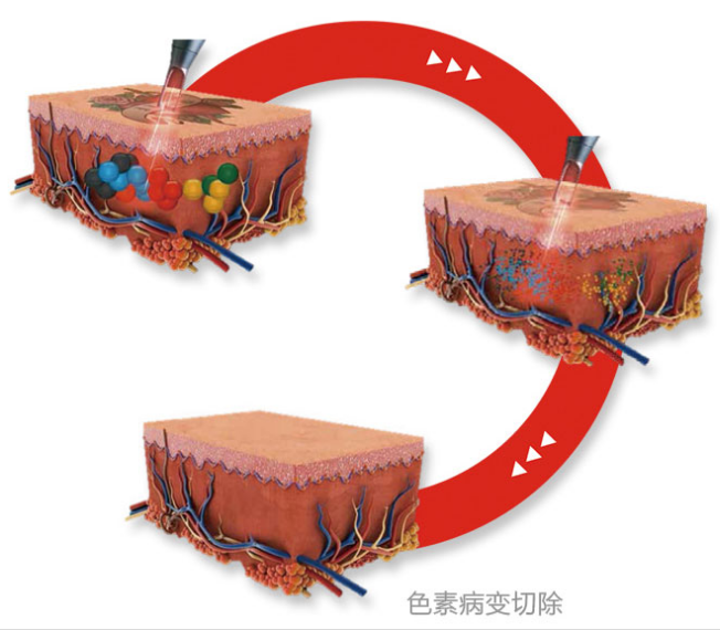  Photoelectric beauty training